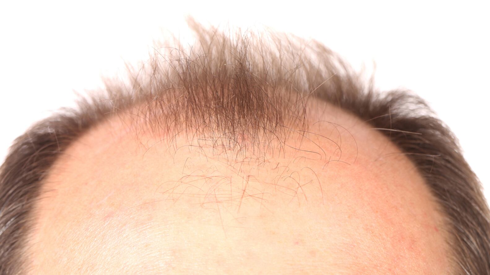 La calvicie suele asociarse con la edad pero esto llega a afectar debido al padecimiento de alopecia. (Shutterstock)