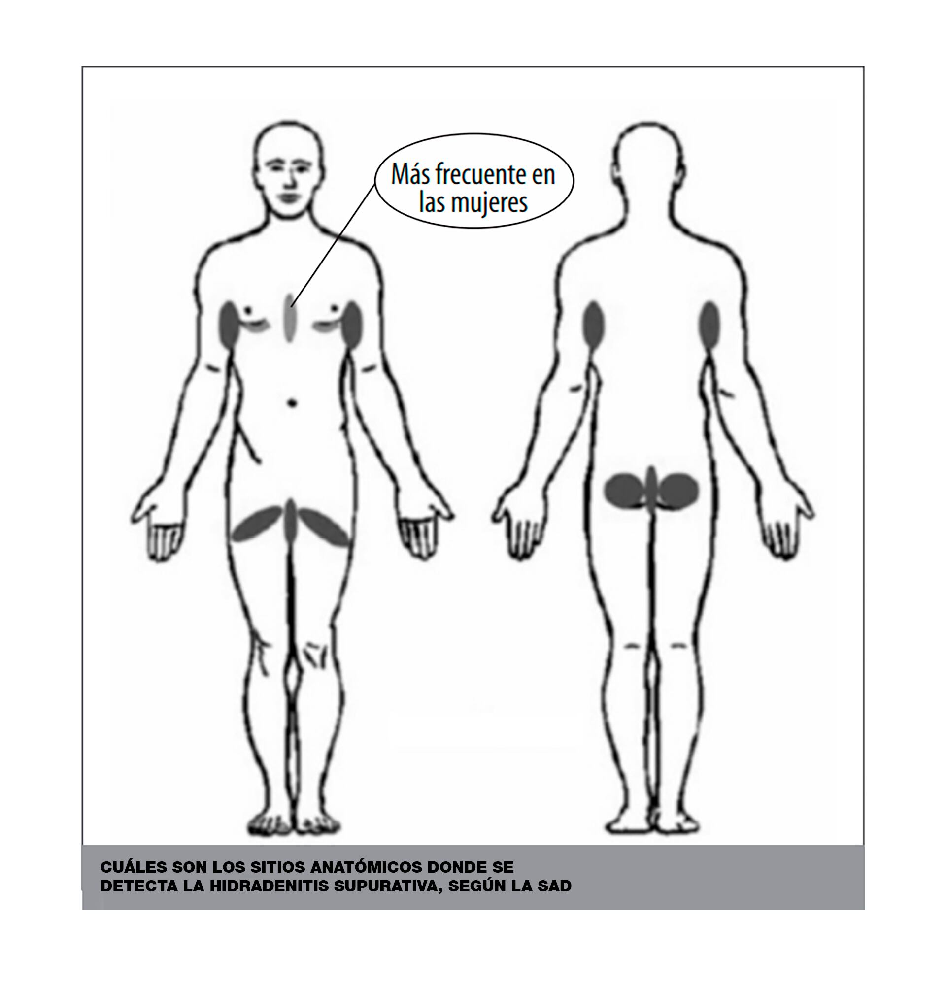 Cuáles son los sitios anatómicos donde se detecta la hidradenitis supurativa, según la SAD