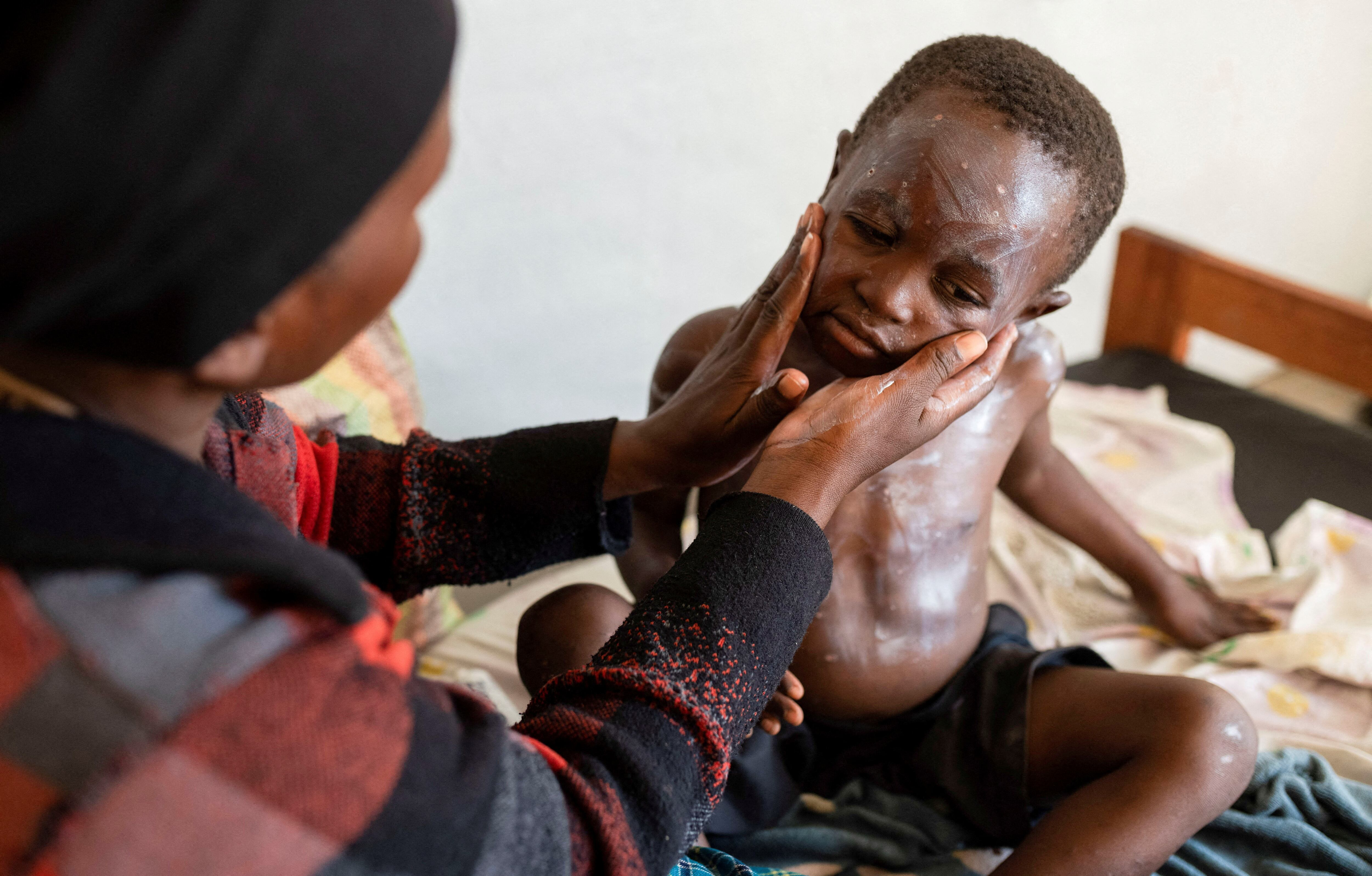 La emergencia de salud pública por mpox fue declarada el 14 de agosto después del aumento de casos en la República Democrática del Congo (REUTERS/Arlette Bashizi)