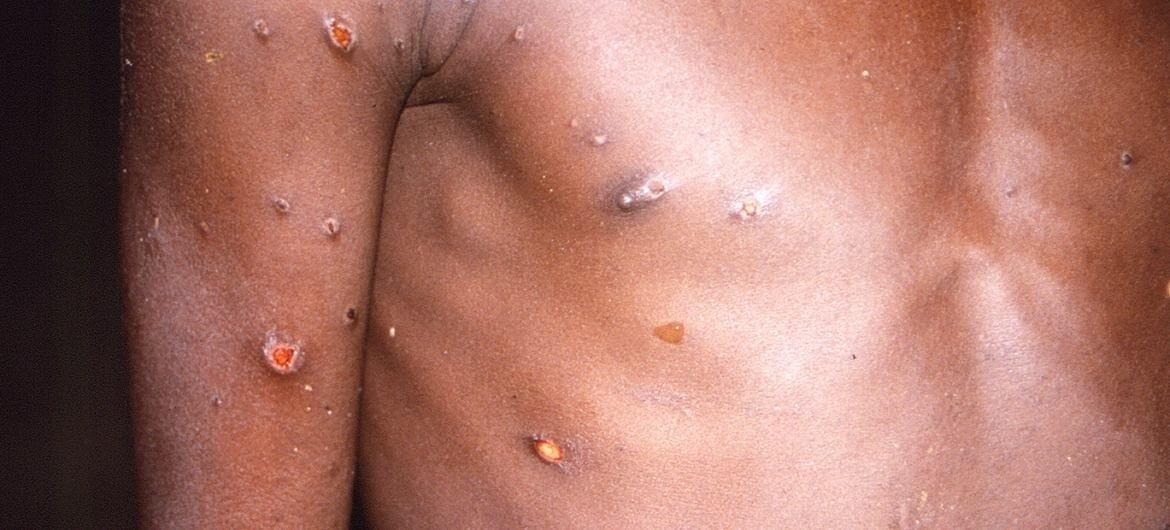 La viruela del mono produce lesiones cutáneas, fiebre y dolor corporal en las personas afectadas por el virus (Foto de archivo)