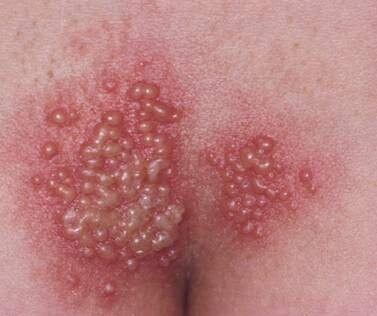 Herpes genital en glúteos