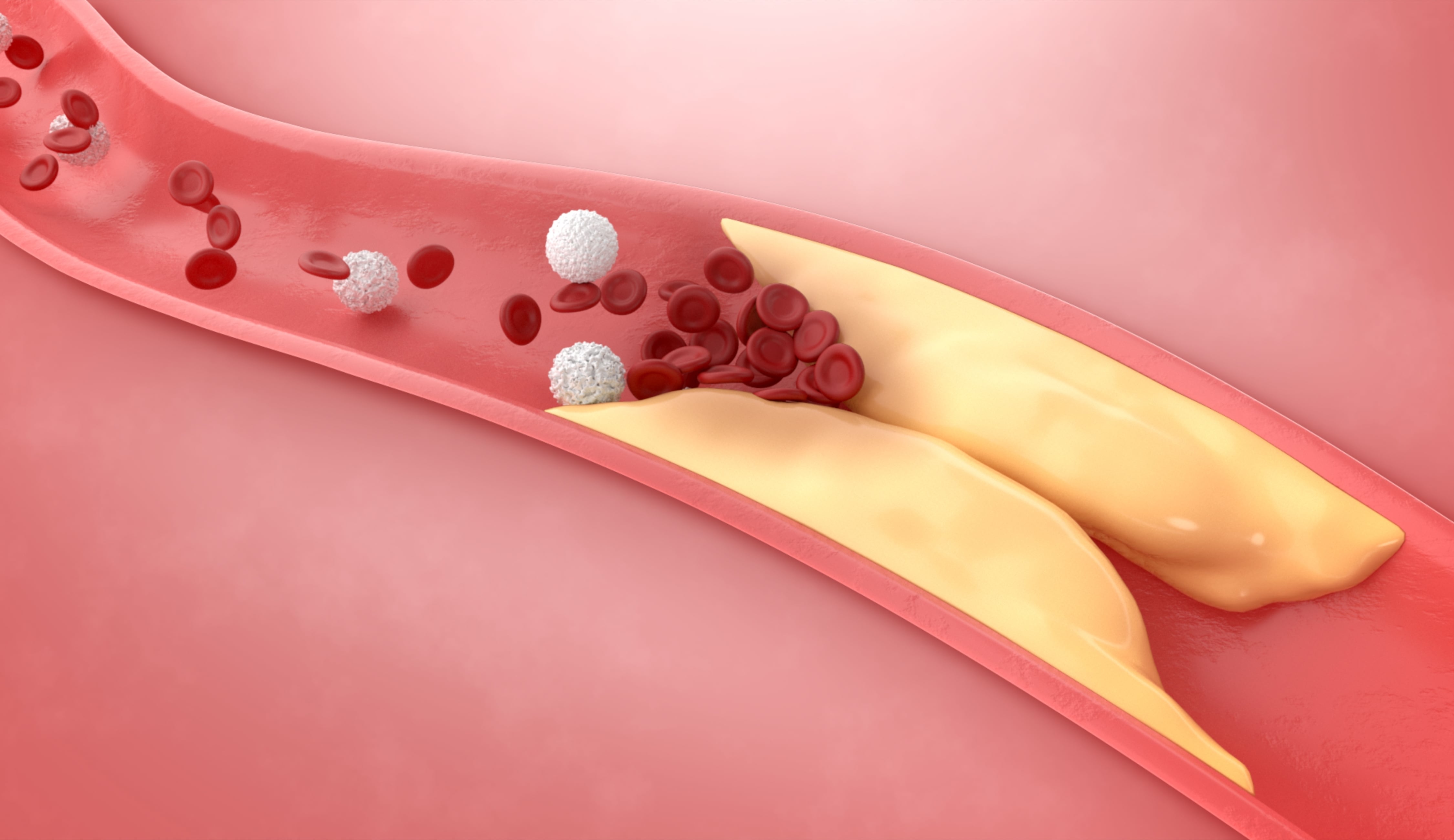 Arterias con colesterol (Shutterstock)