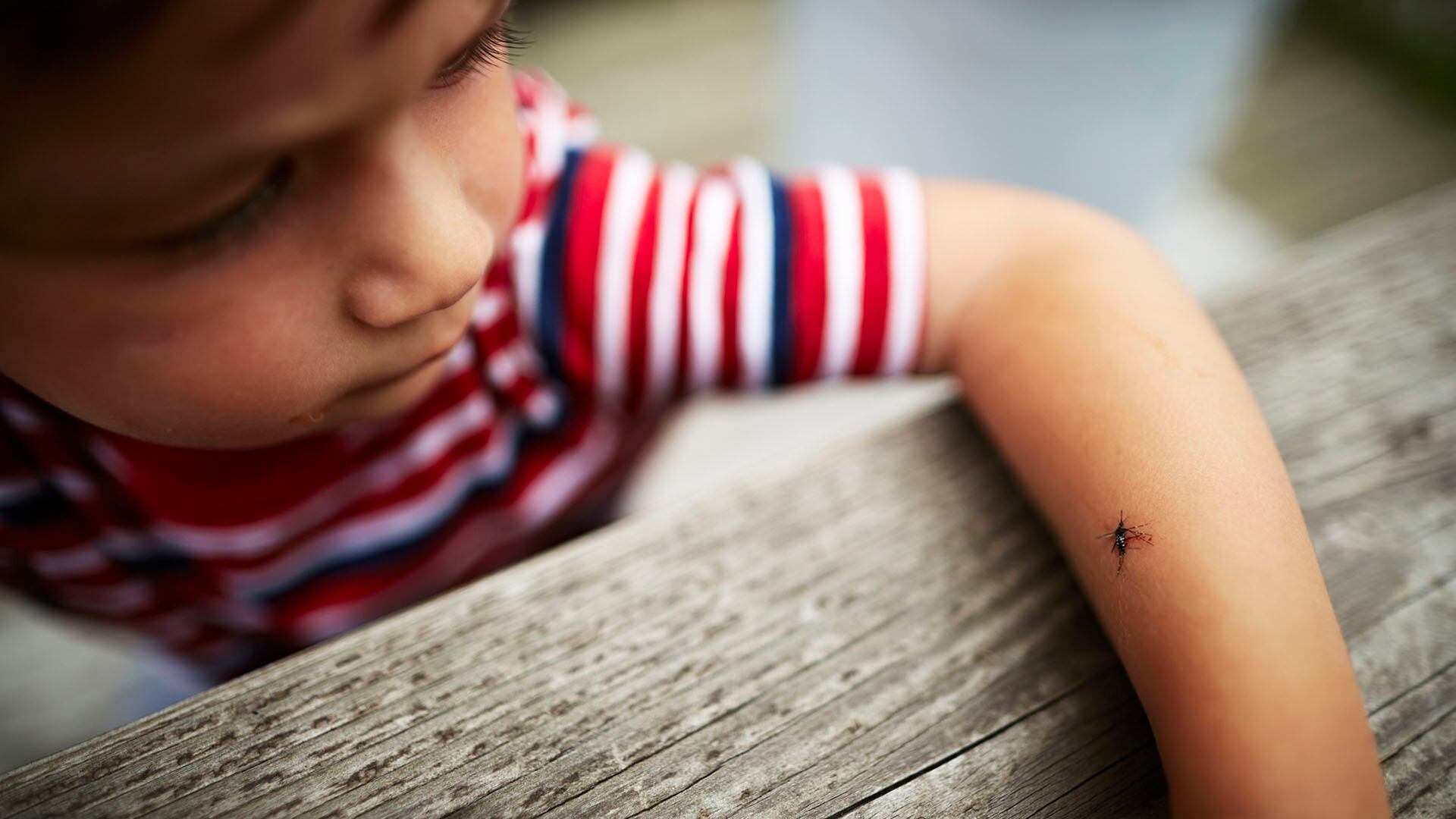 Boy with dead mosquito on his arm