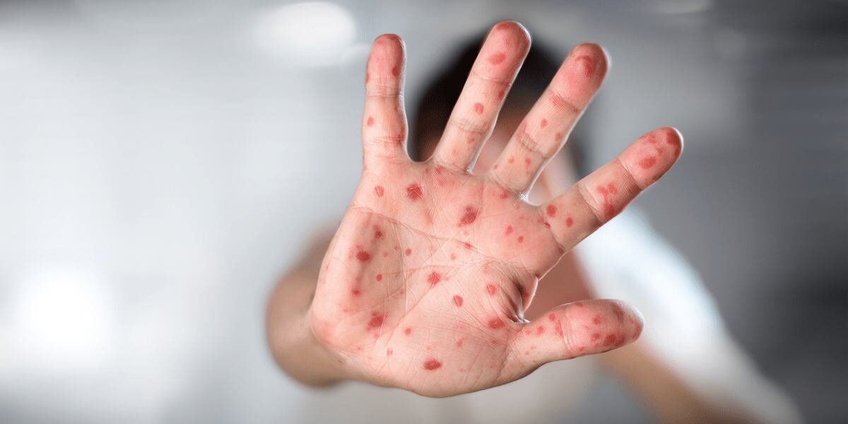 La mano de un hombre con erupciones en la piel producto de la viruela del mono (Grupo Health Care)