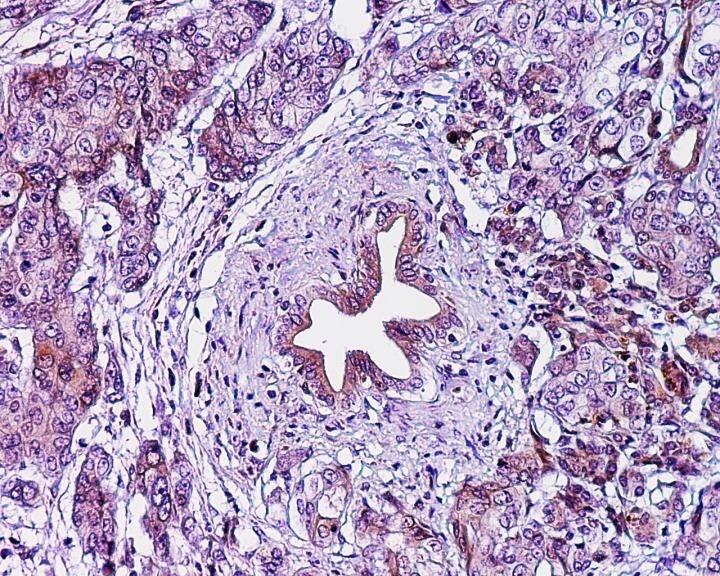 Adenocarcinoma ductal pancreático en una observación microscópica de cáncer páncreas ( KEN ZARET) 