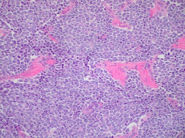 El Día Internacional del Sarcoma se conmemora cada 13 de julio con el objetivo de aumentar la conciencia sobre esta rara patología oncológica y enfatizar la importancia de la detección temprana que mejora significativamente las perspectivas de tratamiento 09/07/2015 Sarcoma de Ewing ESPAÑA EUROPA MADRID SALUD FLICKR/ED UTHMAN 