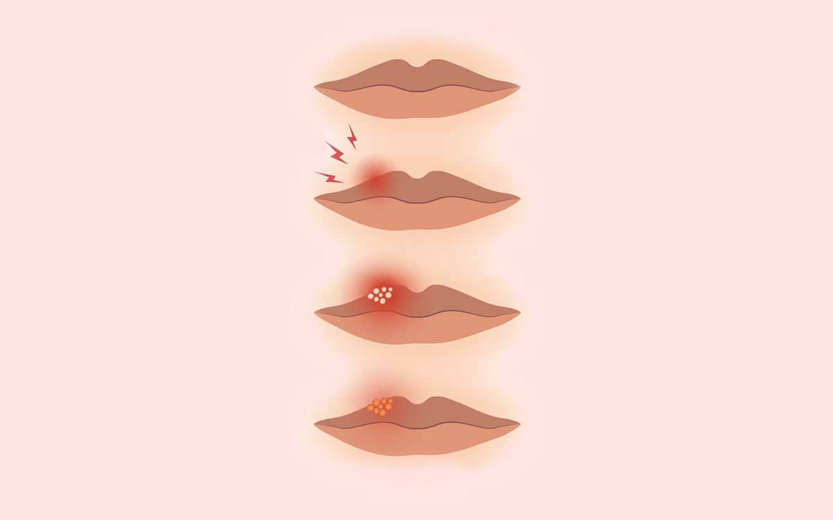 Diferentes fases del herpes labial