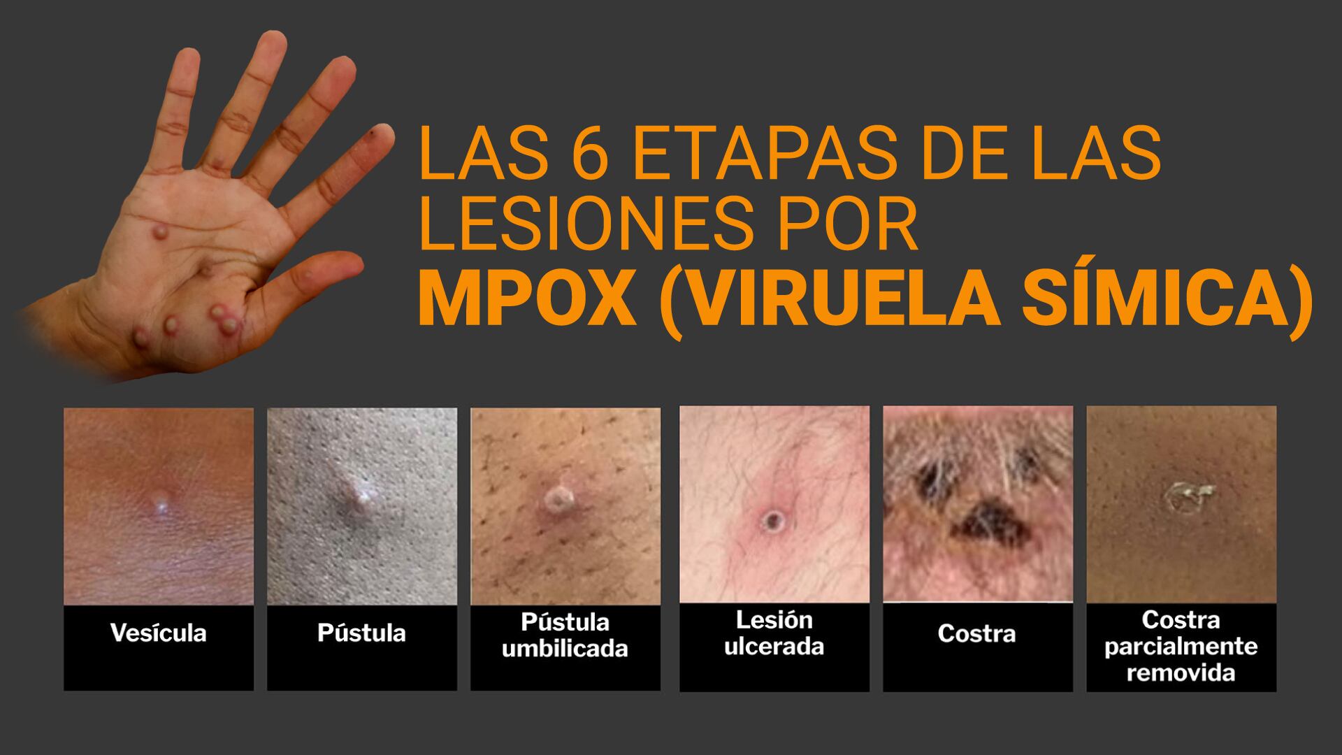 La viruela símica puede transmitirse a los seres humanos por contacto físico con personas infectadas, materiales contaminados o animales infectados