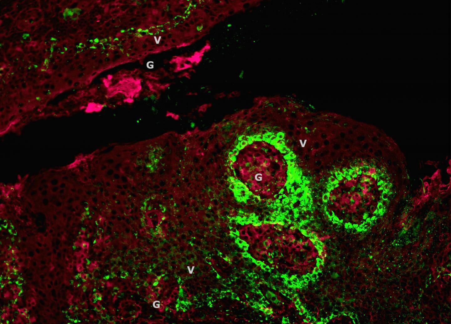 Se trata de criptas amigdalinas con virus del papiloma humano (VPH; verde) en las capas epitelial y de biofilm (rojo) ("V" = biofilm; "G" = VPH; aumento original &veces;20).  CRÉDITO Katherine Rieth. M.D.