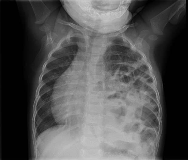 Radiografía de los pulmones de un bebé - Neumonía infantil (Neumología Peruana)