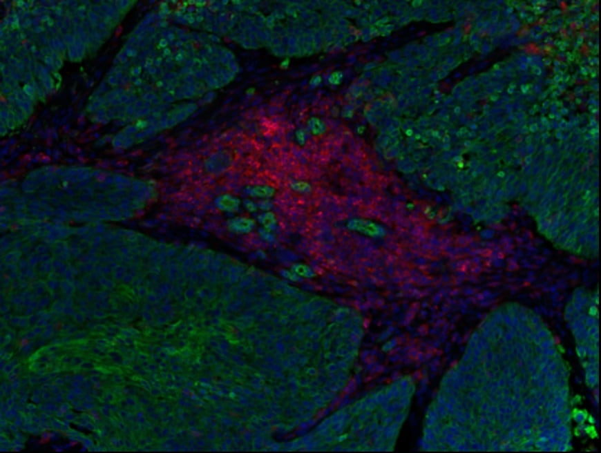 La investigación continúa buscando respuestas para mejorar la prevención y el tratamiento del cáncer en comunidades desfavorecidas, que aún enfrentan tasas más altas de mortalidad (CNIO). 