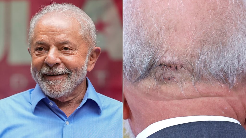 Lula da Silva Emerges from Emergency Brain Surgery Following Sudden Fall